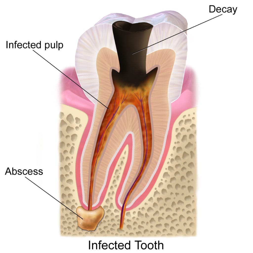 Tooth Abscess – Complete Family Dental